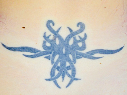 LKZ Tattoo Entfernung